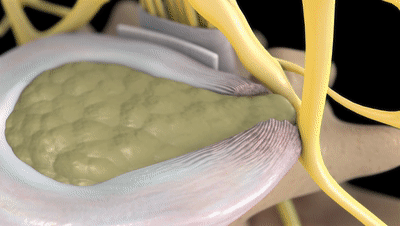 6个缓解腰椎间盘突出的伸展运动，避免7个训练，强壮腰椎不踩雷