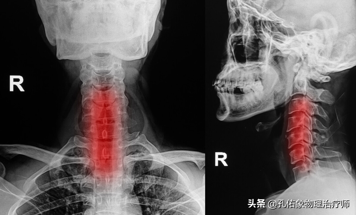 颈椎病很困惑，要如何治疗呢？一文详细告知您不一样的策略方法