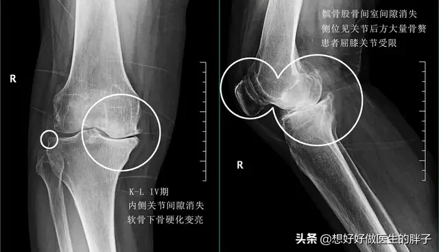 膝盖髌骨软骨磨损后，上下楼梯疼，有响声，平路没事，能治好吗