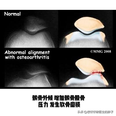 膝盖髌骨软骨磨损后，上下楼梯疼，有响声，平路没事，能治好吗