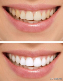 [健康知识普及行动] 口腔预防保健篇之如何让您的牙齿更健康更美白