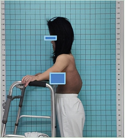 “两次手术失败 我还有希望吗”“翻修+加固”助特殊妈妈重获新生