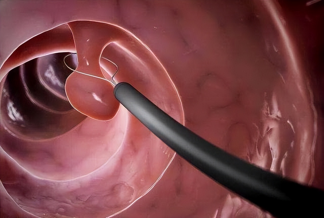 肠镜检查痛苦吗多少钱(肠镜到底有多痛) - 价格百科