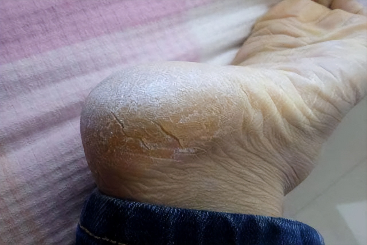 为什么只有脚后跟的皮肤干裂？4个因素是重要原因，要进一步检查