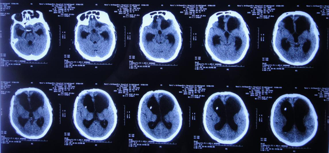 脑外伤颅骨修补术和分流术后脑积水加重致昏迷