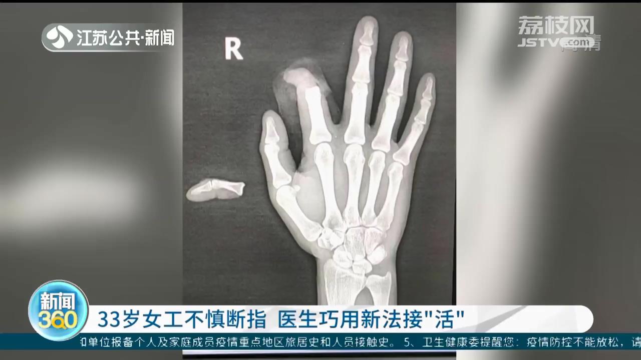 年轻女工不慎断指 医生尝试新方法接&ldquo;活&rdquo;