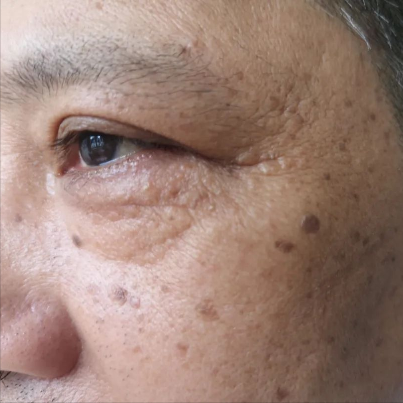 扁平疣和老年疣,傻傻分不清