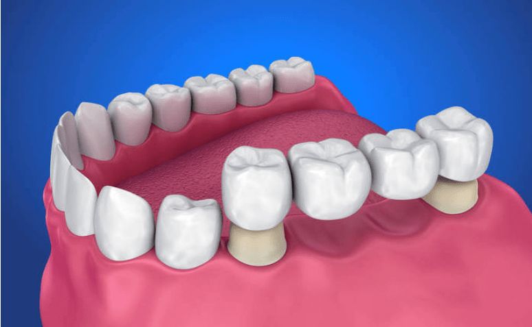 中老年人缺牙，选择固定假牙还是活动假牙好？牙医告诉你答案