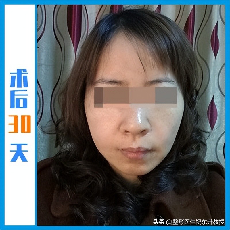 48岁把拉皮手做了，术后16天-120天，无P图 不美颜 真实反馈