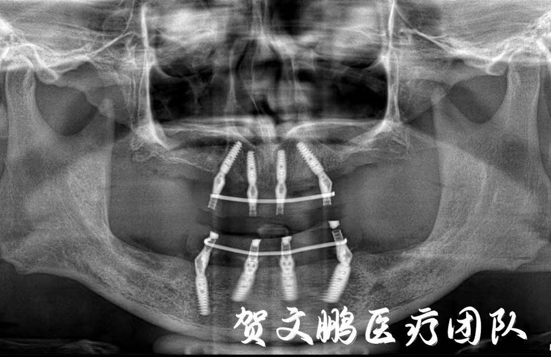 牙齿掉光还有高血压？精确种牙即刻恢复咀嚼功能