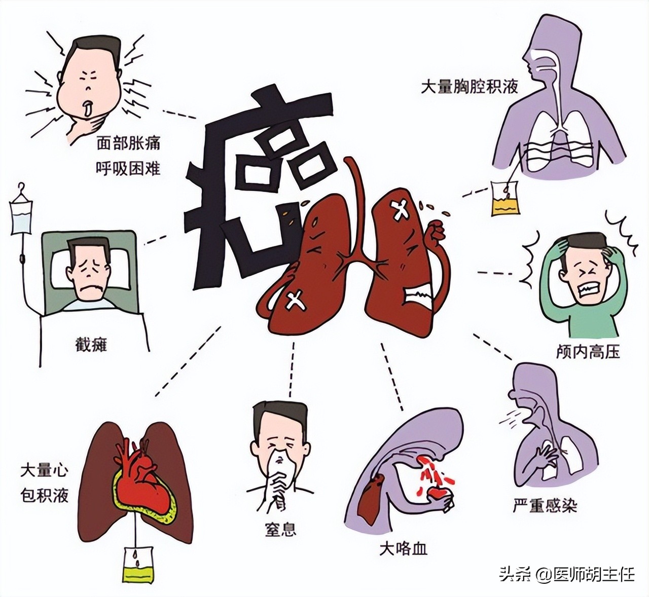 肺有癌，睡觉能提前预知？若出现这4种现象，劝你早做CT检查