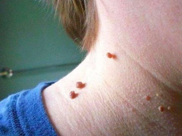 脖子上、腋下长了小肉粒是什么？能用手抠掉吗？医生这么说