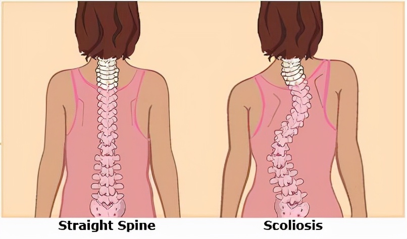 治疗脊柱侧弯花费近13万，能报销多少？6个问题，解答大家的疑惑