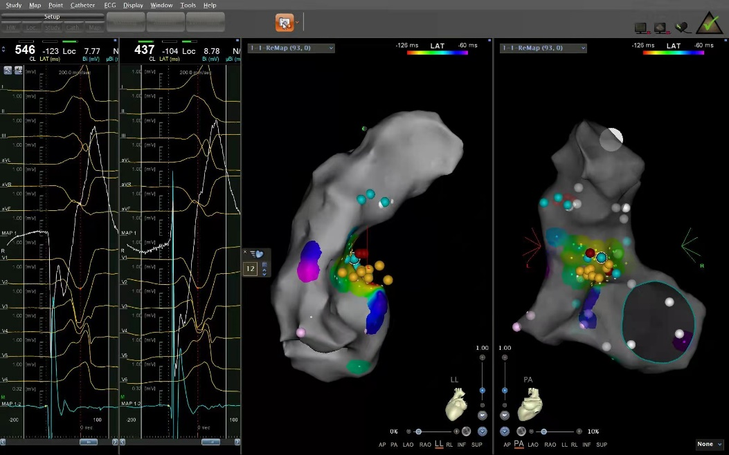 仁医病例丨方哲参与指导多例疑难性室早射频消融治疗