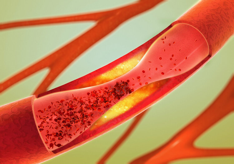 花生，到底是护血管还是伤血管？怎么吃才正确？