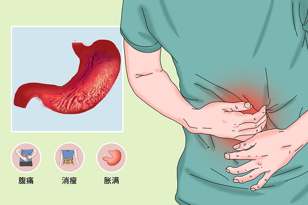 慢性萎縮性胃炎，中醫1方，益氣健脾，消食和胃，修復胃黏膜損傷