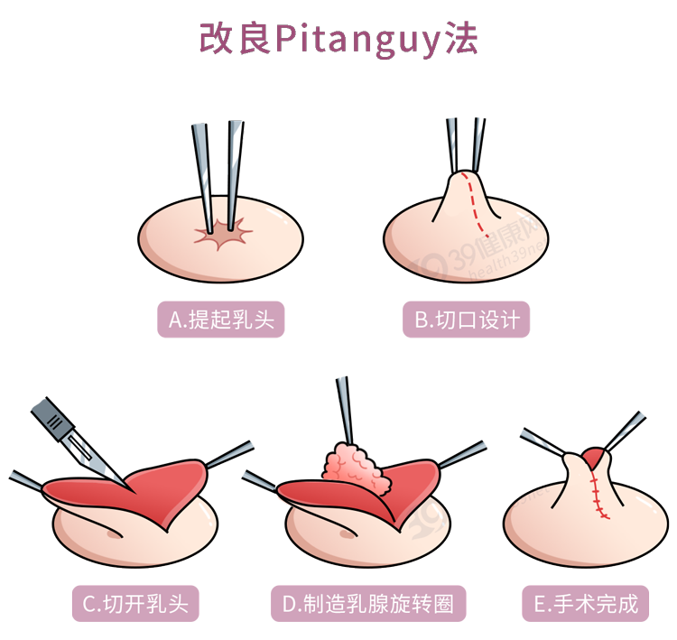 乳头内陷什么医院(什么是“乳头内陷”？要怎么治疗？2个原因，可能让它暂时消失)