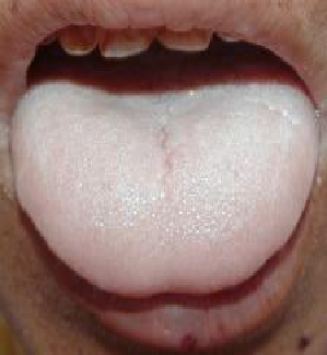 所谓舌质:就是舌头的肉质,舌苔:就是肉质表面覆盖的一层苔藓样的东西