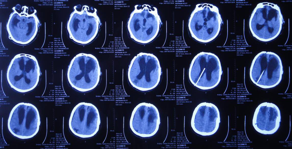 脑外伤颅骨修补术和分流术后脑积水加重致昏迷