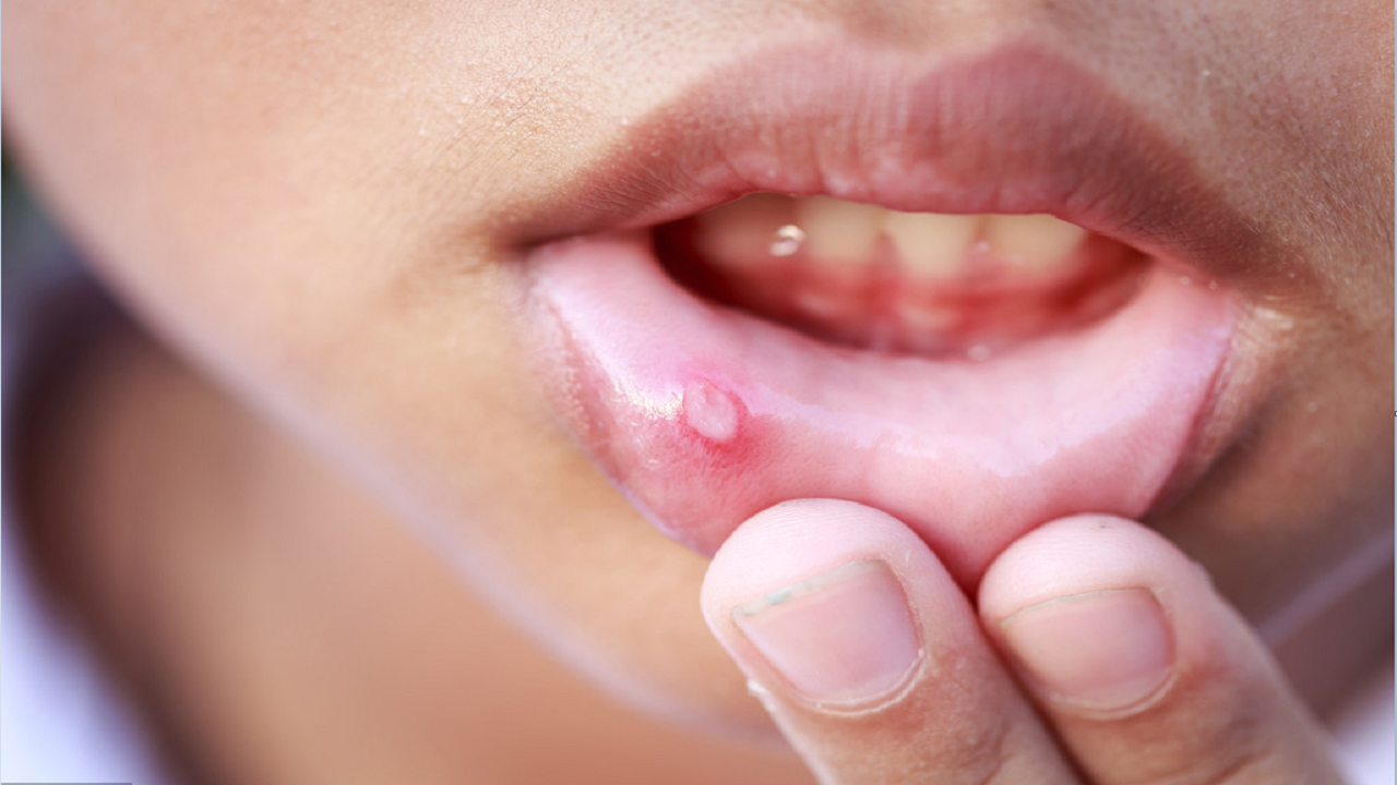 口腔溃疡是局部的黏膜病变,跟上火,烫伤或肠胃不佳有关系,经过调理后