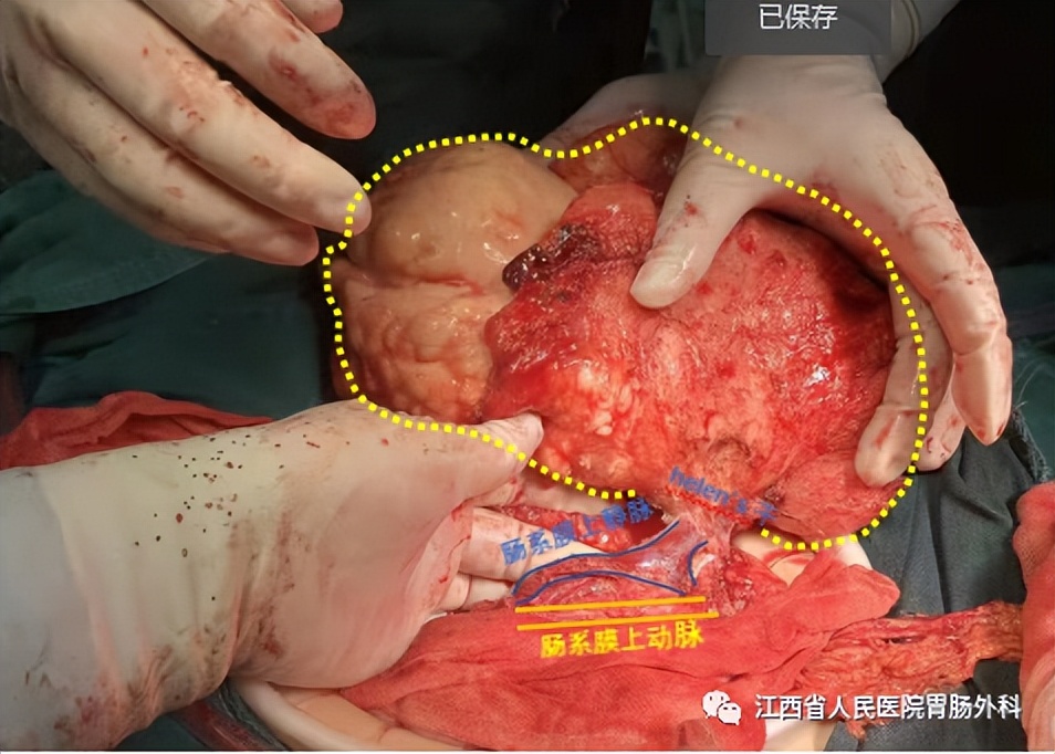 花季少女腹藏巨大肿瘤！省人民医院精心“拆弹”解难题