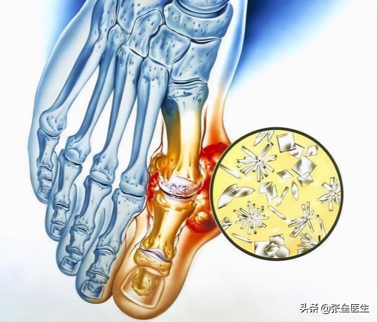 痛风不能吃豆制品？医生：错了错了，管理好4点，痛风对你靠边走