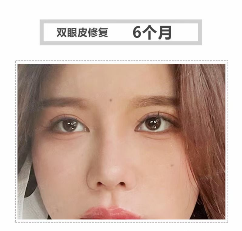 双眼皮修复6个月新照片反馈——是不是修不出其他形态的双眼皮?