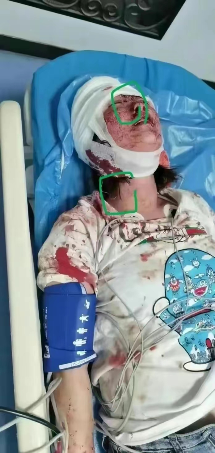 “唐山”被打女子伤情曝光，歹徒量刑或加重，“黑伞”也保不住他