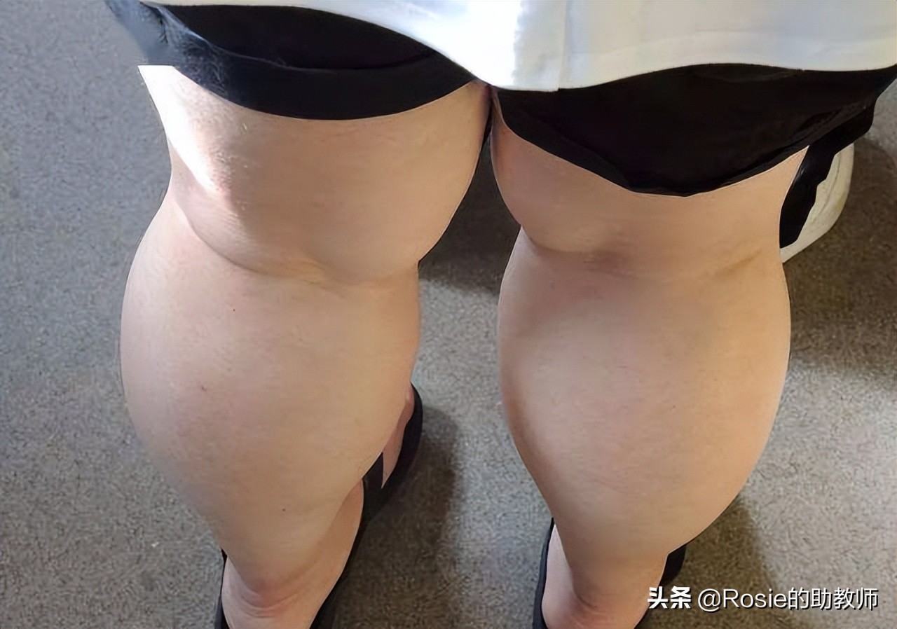 何穗晒照胳膊小腿一样粗，小腿粗壮弯如何瘦？找对成因这样做