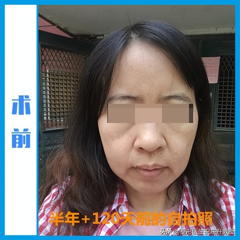 48岁把拉皮手做了，术后16天-120天，无P图 不美颜 真实反馈