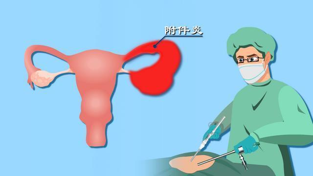 女性内生殖器官当中输卵管,卵巢都被称之为附件,附件炎是指输卵管和