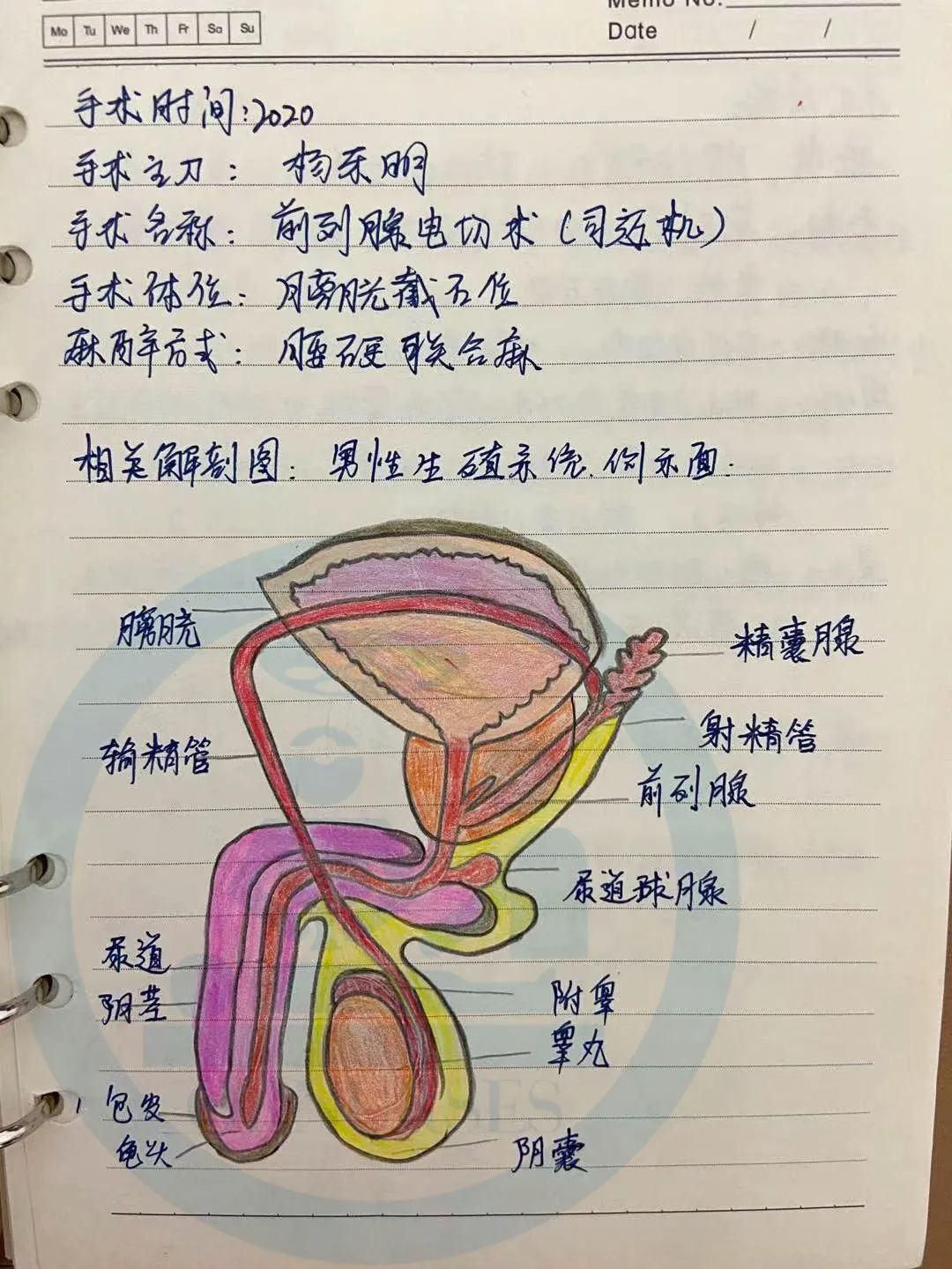 手术笔记：前列腺电切术