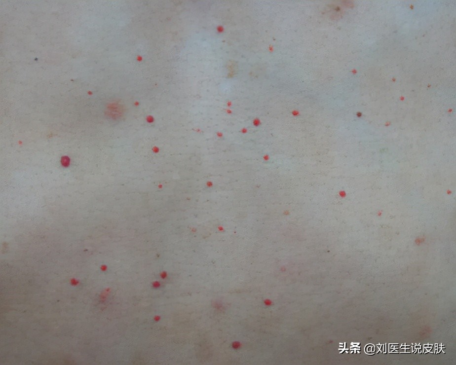 身上长蜘蛛痣，就是肝硬化的征兆？医生：不一定，或会自行消失