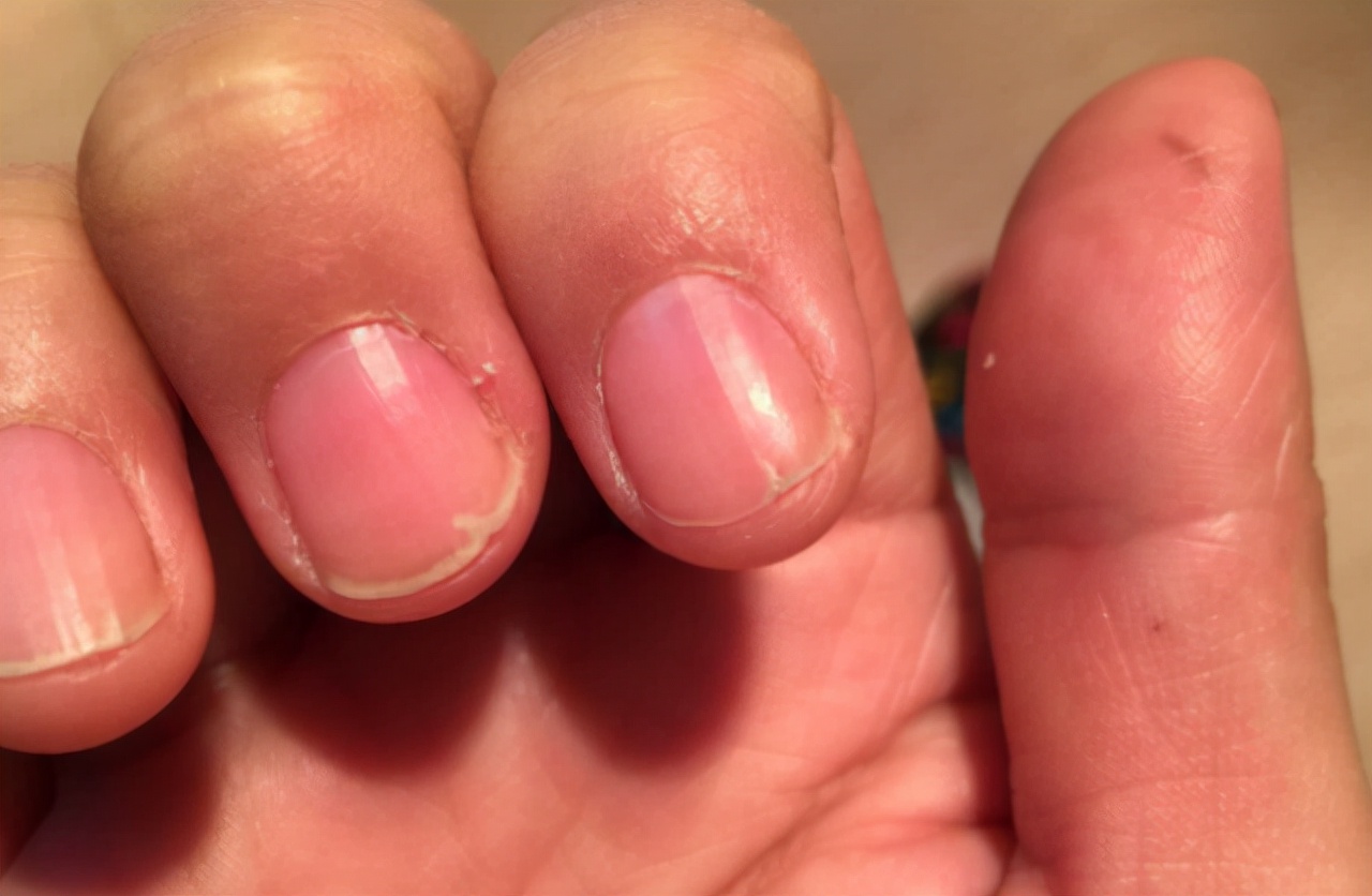 医生忠告:手上出现4种异常,可能与肝脏病变有关,3种人群需重视