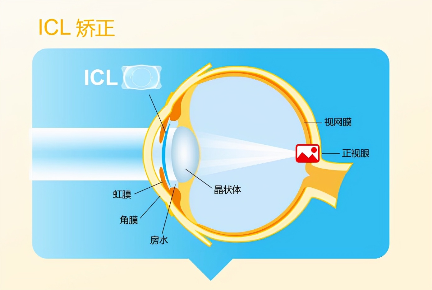 王凯医生工作室丨ICL晶体植入手术全攻略