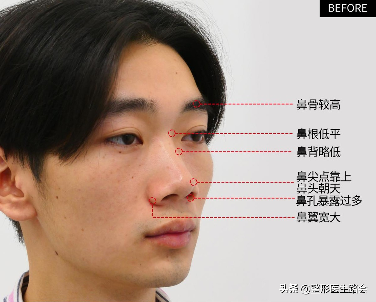 等待2年之久，从海南到北京，鼻整形真实记录，82天后“很惊艳”
