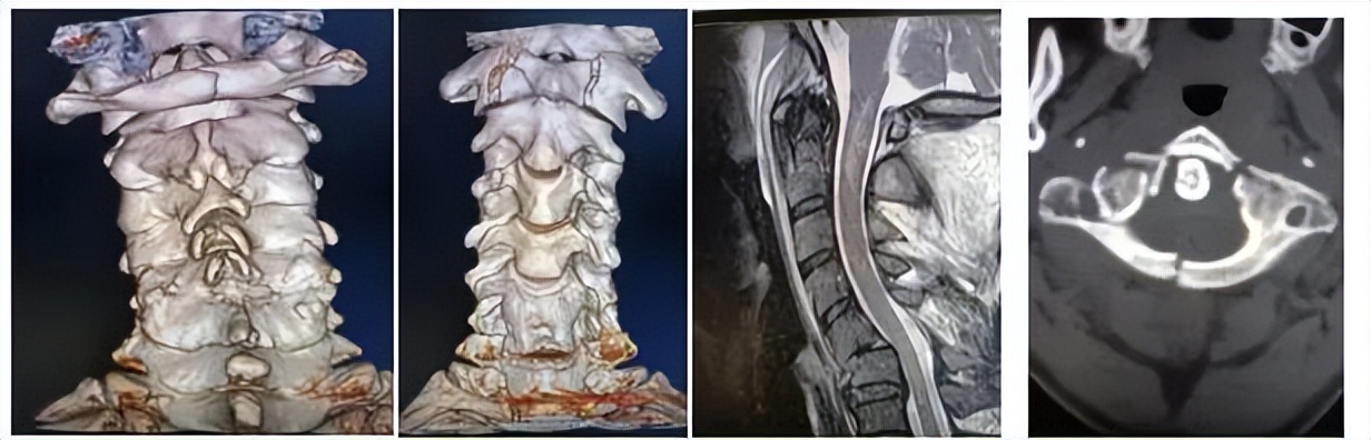渭南市中心医院骨一科成功完成一例高难度复杂上颈椎骨折手术