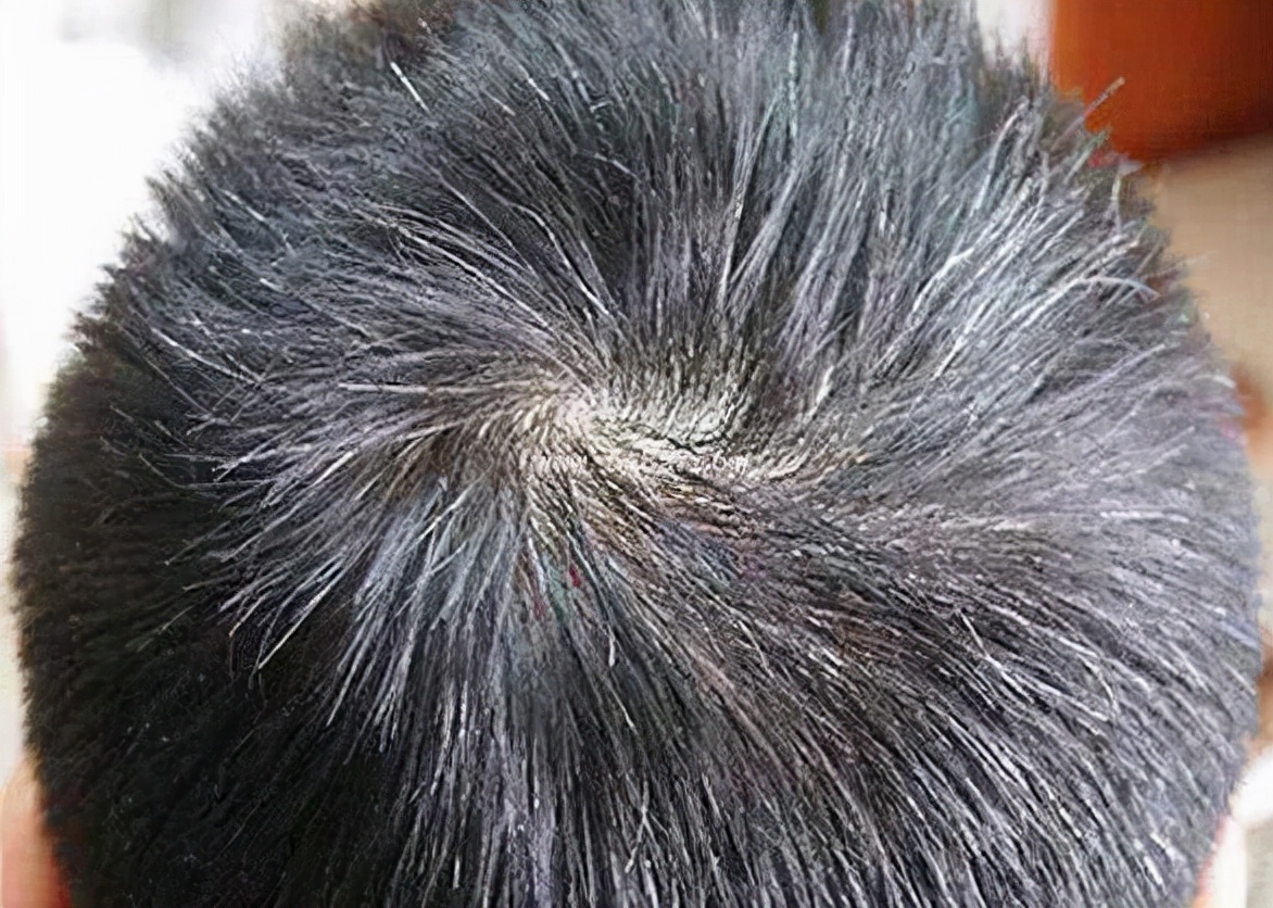 两鬓,前额,后脑勺,不同部位长白发,分别代表了啥?