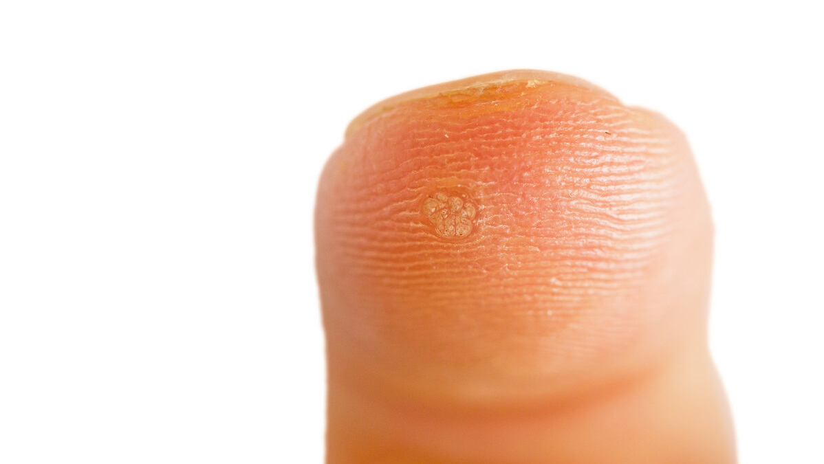 很多人身上会莫名冒出一些小疙瘩,小肉粒,虽然不会感到疼痛和瘙痒
