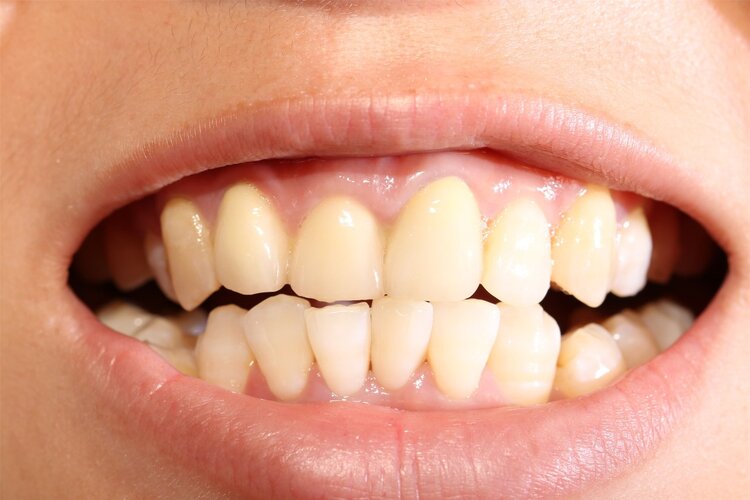 导致牙龈萎缩的5个原因，现在改正过来，老了依然有一口好牙