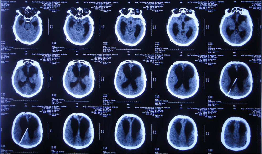 脑外伤颅骨修补术和分流术后脑积水加重致昏迷
