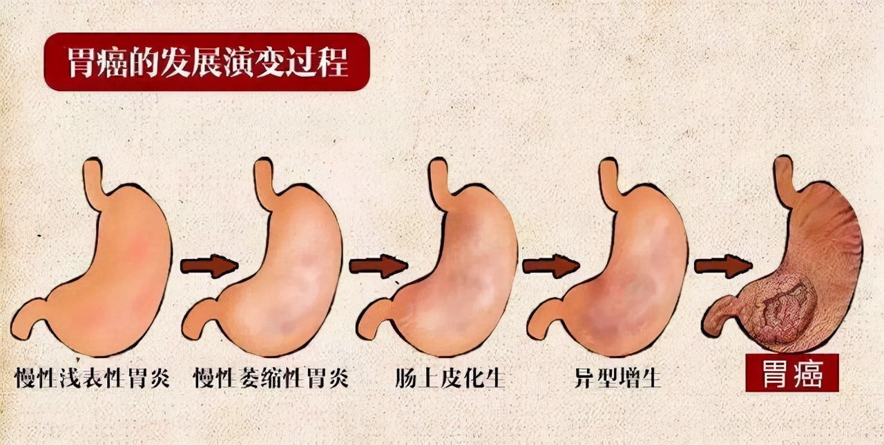 从“炎症”到癌症，一般需要多久？建议：这三种炎症尽量不要拖延