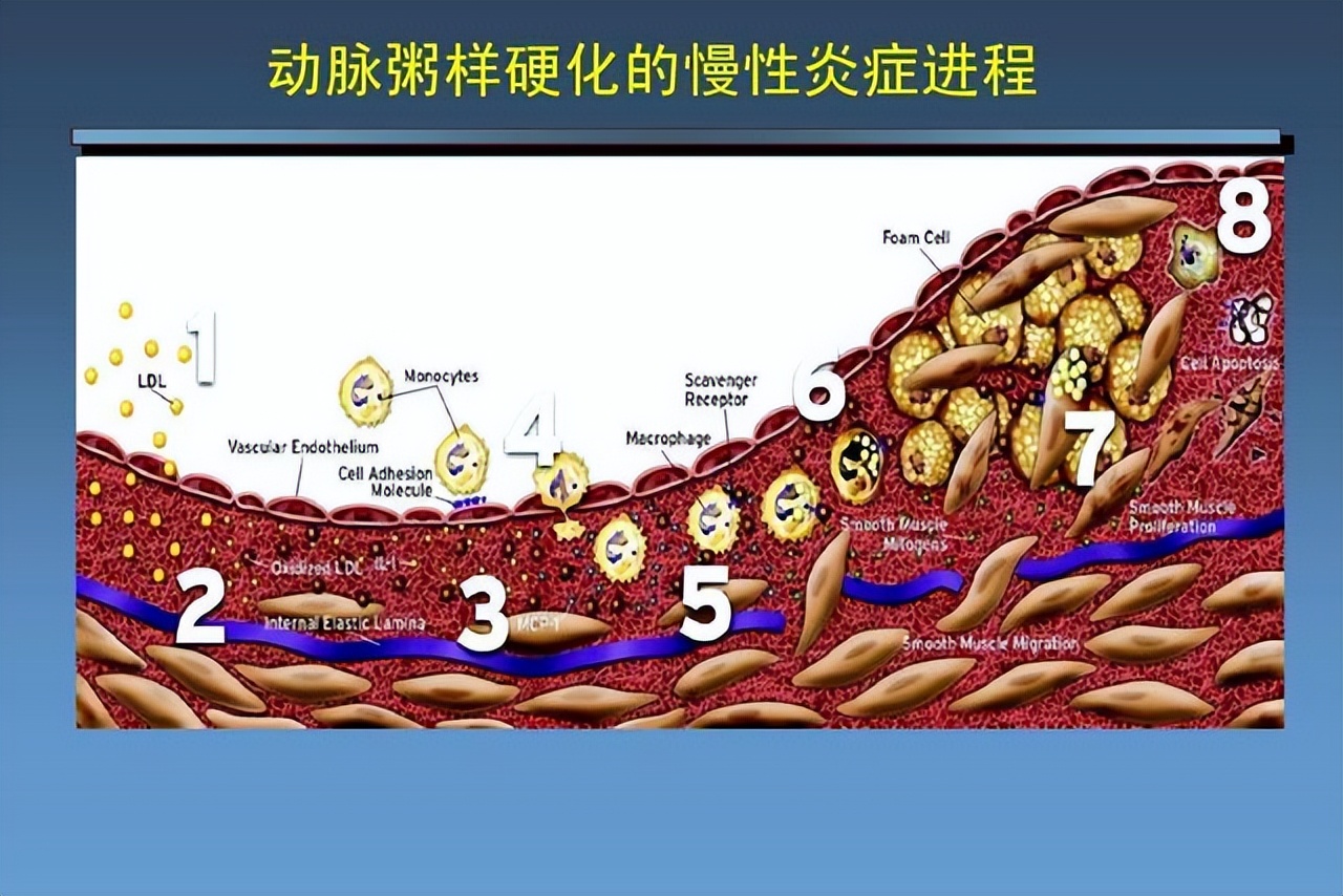 胆固醇越低，癌症风险越高吗？要怎样控制血脂健康？建议看看