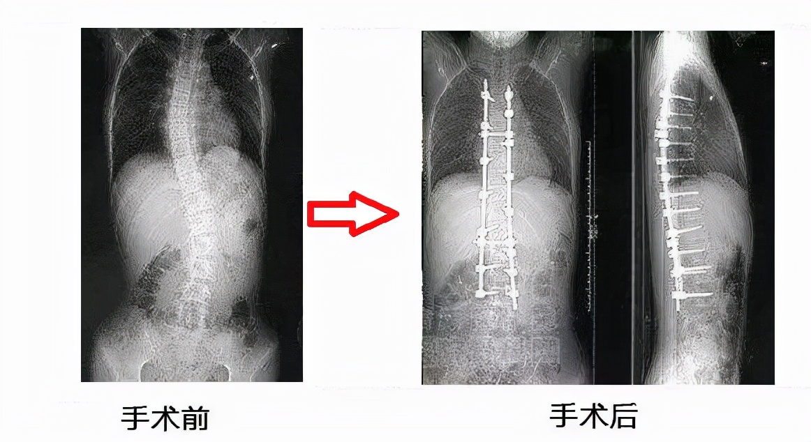 治疗脊柱侧弯花费近13万，能报销多少？6个问题，解答大家的疑惑