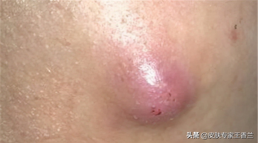 ①病因:首先,疖子并不是上火导致的,它是由细菌感染毛囊炎所导致的.