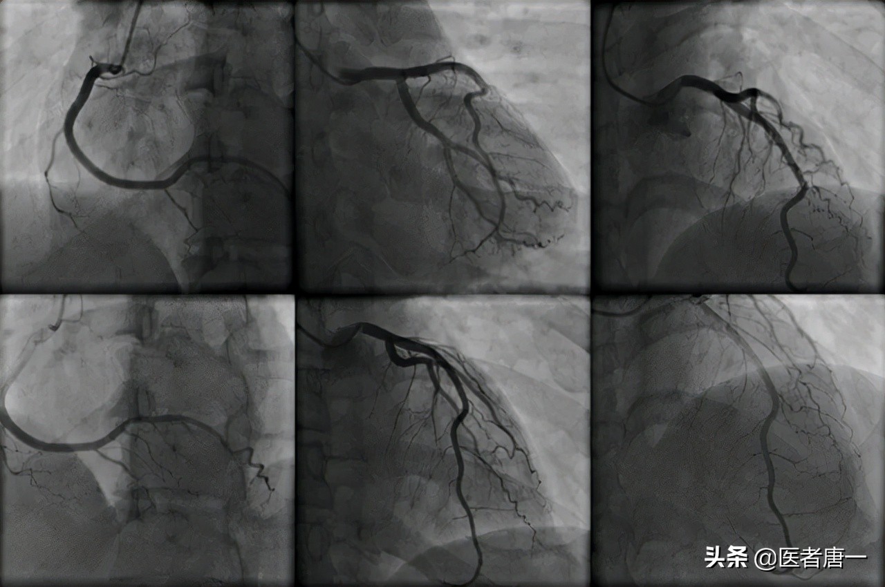做冠脉造影检查后寿命变短？听听医生怎么说