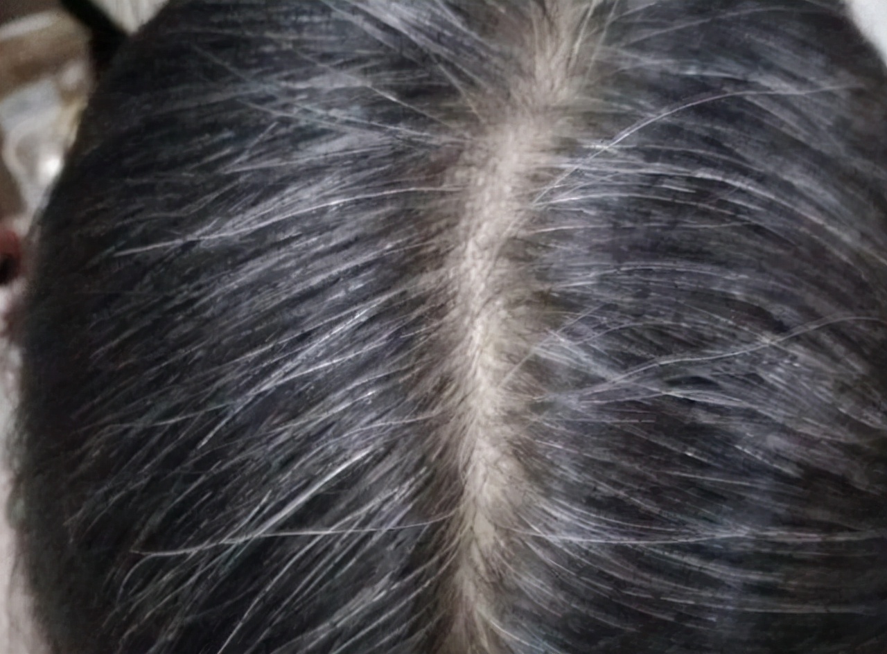 为什么白头发越长越多？你以为是老了，医生：或是缺乏2种营养素