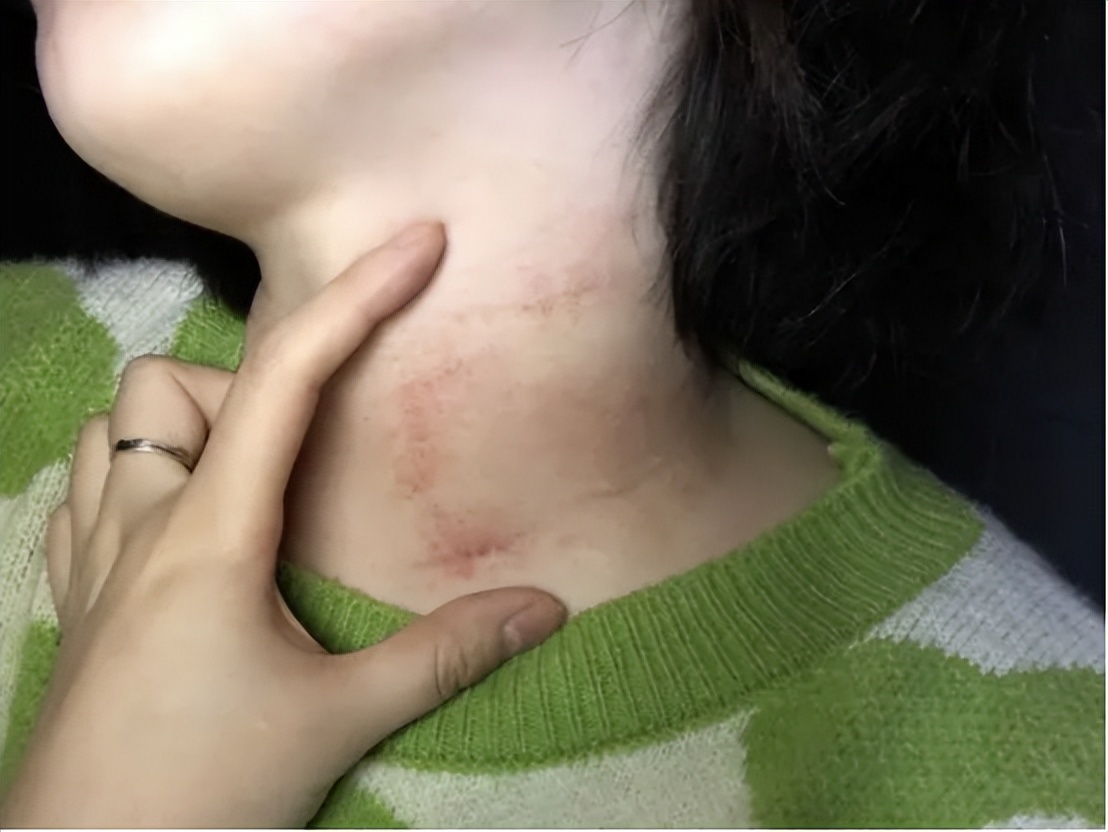 脖子上长出了"小肉粒",别只顾影响美观,也会影响健康