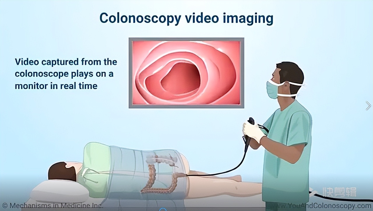 为何很多人排斥肠镜？做一次肠镜“有效期”是多久？一文讲清