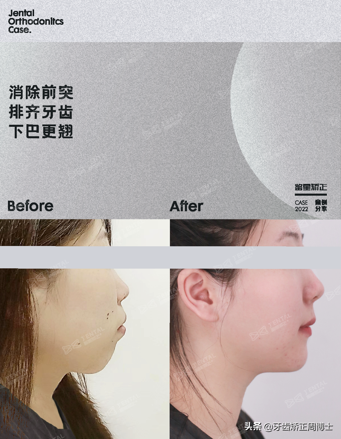 牙齿前突矫正要多少钱(重度骨性前突) - 价格百科